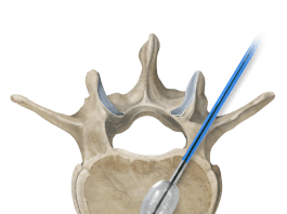 Osteo-Site Vertebral Balloon