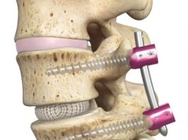 Spineology OptiMesh® Expandable Interbody Fusion System