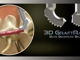 3D GraftRasp System