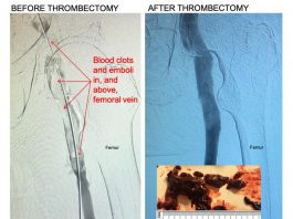 Control 11F Mechanical Thrombectomy System