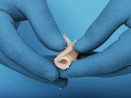 TheraCell, Completes 1st Surgical Case with Its TheraFuze DBF Fiber Wrap That Offers Surgeons an Improved Solution for Graft Containment