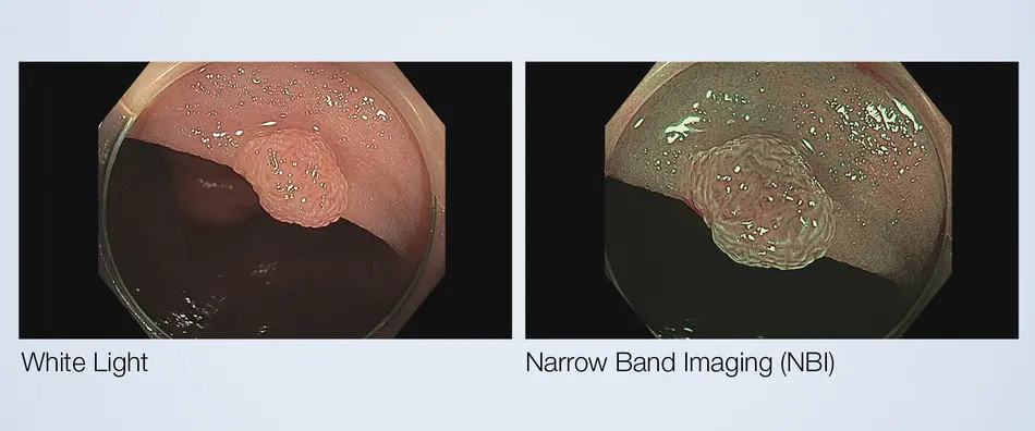 Narrow Band Imaging