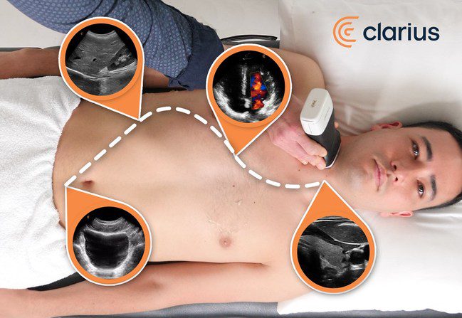Clarius, Introduces First Ultrasound System That Uses AI and Machine Learning to Recognize Anatomy for an Instant Window into the Body