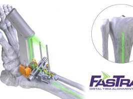 Paragon 28, Conducts the First Total Ankle Joint Replacement Surgery Utilizing Laser Alignment Technology