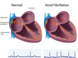 ACC, HRS, Bristol Myers Squibb-Pfizer Alliance to Transform AFib Care in Underserved Communities