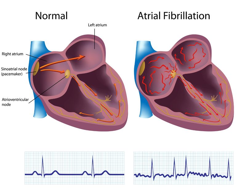 ACC, HRS, Bristol Myers Squibb-Pfizer Alliance to Transform AFib Care in Underserved Communities