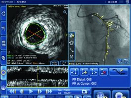 DEFINE GPS, study first patient enrolled