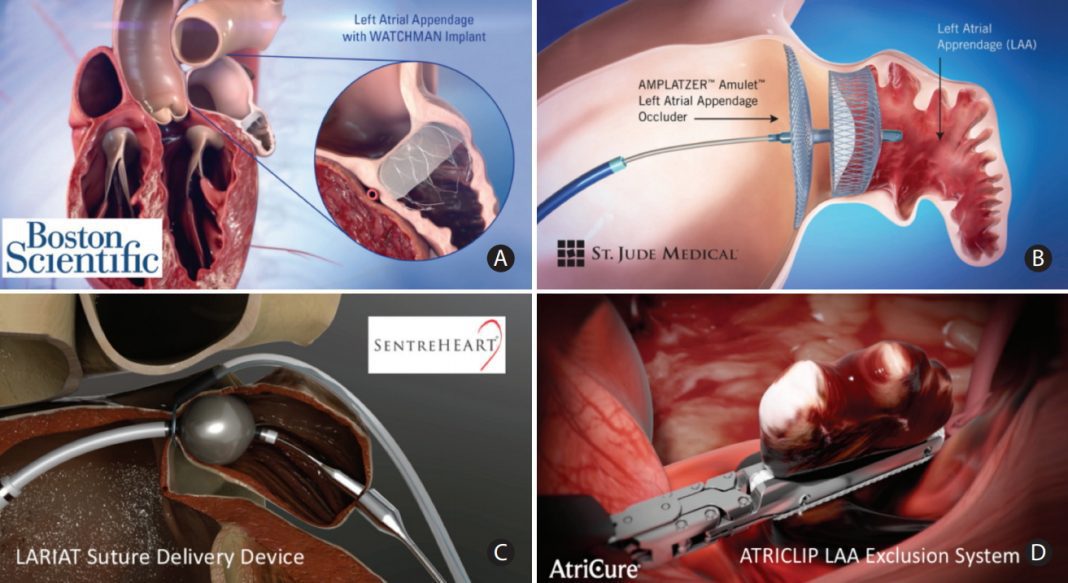 HRS Scientific Sessions: Boston Scientific LBCT