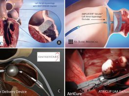 HRS Scientific Sessions: Boston Scientific LBCT