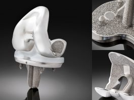 Truliant Porous Knee System Launches Reports Exactech