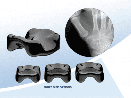 Ensemble Orthopedics Announces 35th Implantation Of Minimally Invasive CMC Device To Be Showcased At 2021 ASSH Meeting