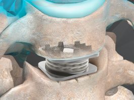 Orthofix Announces Milestone: More Than 60,000 M6-C Artificial Cervical Discs Implanted Worldwide