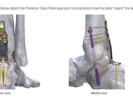 Paragon 28 Increases its Robust Hindfoot Fusion Plating Offering, Launching the Silverback™ Span Plating System