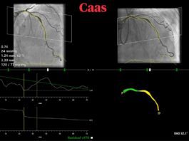 News Pie Medical Imaging Announces FASTIII, a Multicenter Randomized Clinical Trial