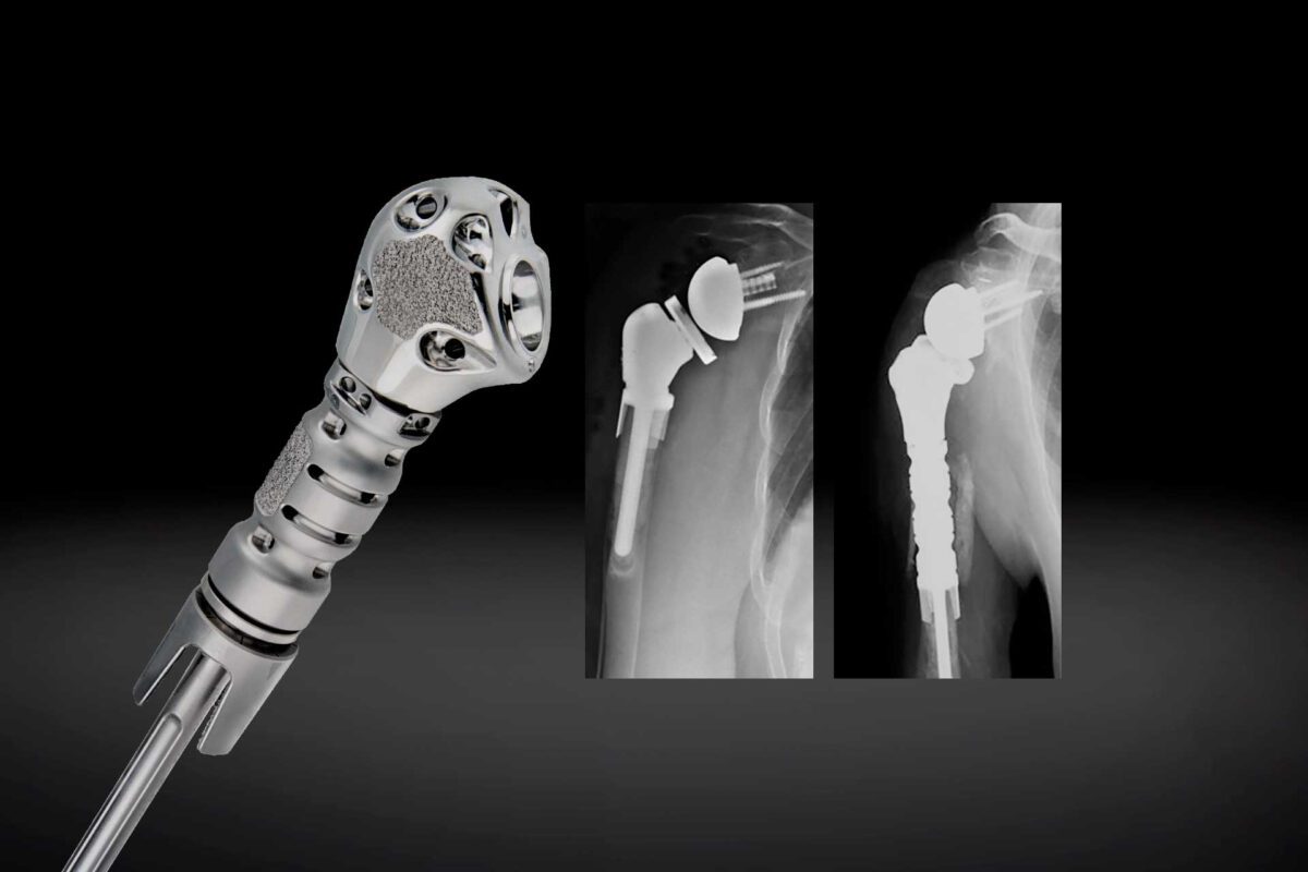 Exactech Announces Launch of Humeral Reconstruction Prosthesis in Europe