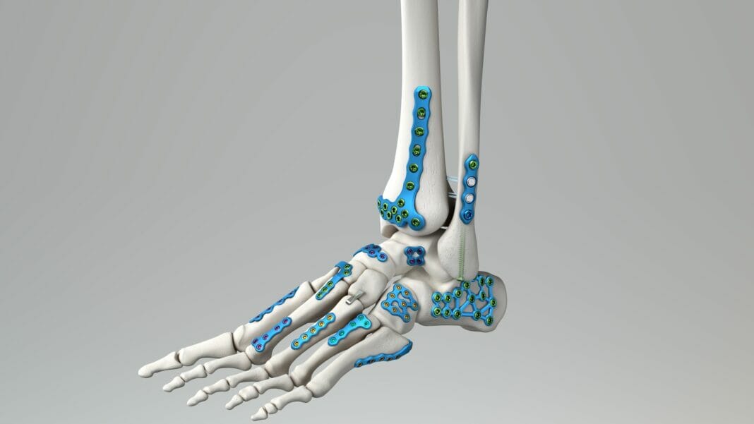 Medline UNITE Launches Calcaneal Fracture Plating System & IM Fibula Implant