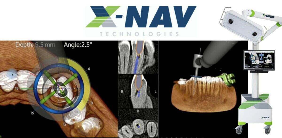 X-Nav Technologies Reports X-Guide Dynamic Navigation Receives FDA 510(k) Clearance To Aid in Minimally Invasive Endodontic Procedures