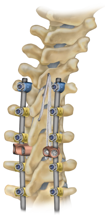 News Medtronic Receives Spine Industry’s First and Only FDA Clearance for Breakthrough Device Indicated for Ligament Augmentation