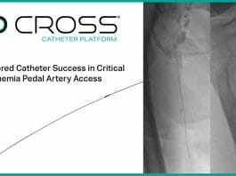 Tapered Catheter Success in Critical Limb Ischemia Pedal Artery Access