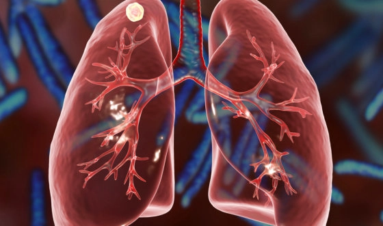 The Best Hospitals for Lung Cancer Treatment