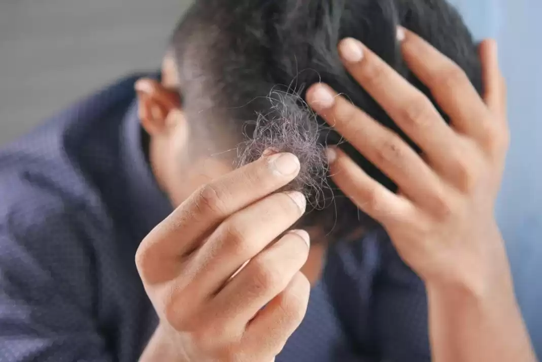 Hair Loss and Alcohol