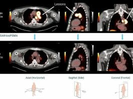 Prostate Cancer Trial