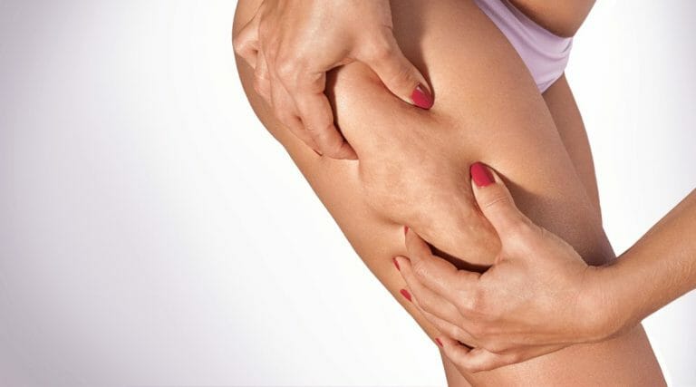 CelluAid Safety- A Trusted Solution for Cellulite Treatment