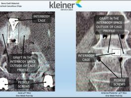 KG2 Surge Flow-Thru Interbody System