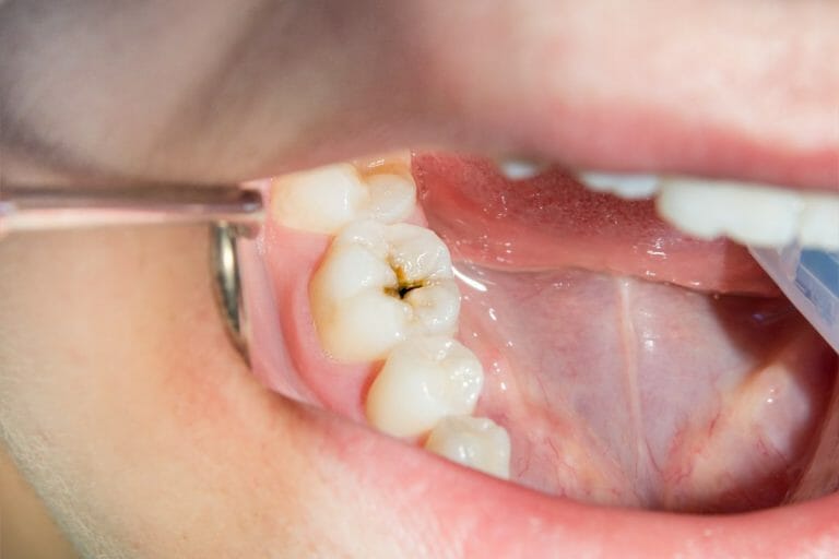 The Aesthetics And Health Implications Of Tooth Decay