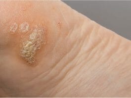 Plantar Warts