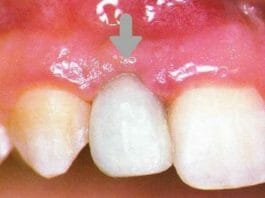 Dental Cement in Orthodontics