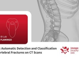 Osteoporotic Fractures of the Spine in CT Scans