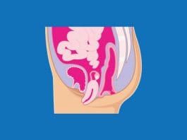 Pelvic organ prolapse