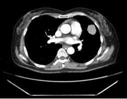 CT Image at Diagnosis