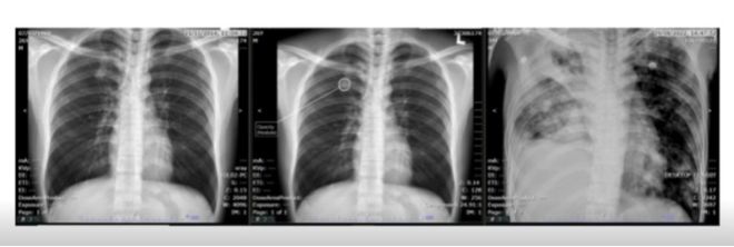 AI can detect lung nodules news