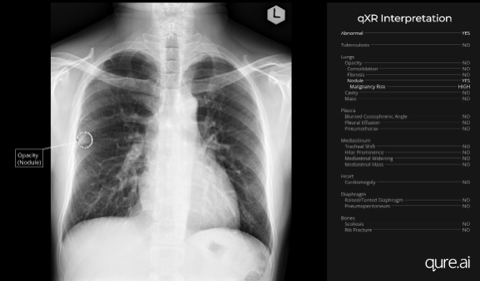 AI can detect lung nodules